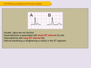 Usually, signs are not obvious Hypercalcemia is associated with  short QT interval  (A) and  Hypocalcemia with  long QT interval  (B). Interval shortening or lengthening is mainly in the ST segment. HYPERCALCEMIA/HYPOCALCEMIA 