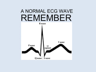 A NORMAL ECG WAVE REMEMBER 