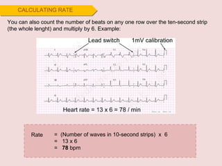 You can also count the number of beats on any one row over the ten-second strip (the whole lenght) and multiply by 6. Example:  CALCULATING RATE =  (Number of waves in 10-second strips)  x  6 =  13 x 6 =  78  bpm Rate  