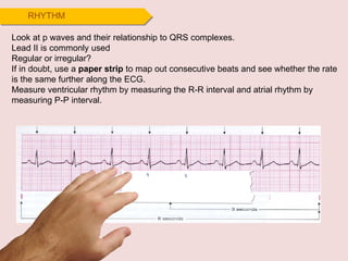 Look at p waves and their relationship to QRS complexes.  Lead II is commonly used Regular or irregular? If in doubt, use a  paper strip  to map out consecutive beats and see whether the rate is the same further along the ECG. Measure ventricular rhythm by measuring the R-R interval and atrial rhythm by measuring P-P interval. RHYTHM 