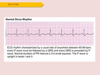 RHYTHM ECG rhythm characterized by a usual rate of anywhere between 60-99 bpm, every P wave must be followed by a QRS and every QRS is preceded by P wave. Normal duration of PR interval is 3-5 small squares. The P wave is upright in leads I and II  Normal Sinus Rhythm 