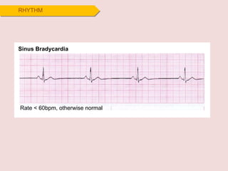Sinus Bradycardia RHYTHM Rate < 60bpm, otherwise normal  
