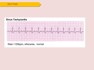 RHYTHM Sinus Tachycardia Rate >100bpm, otherwise,  normal 