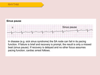 RHYTHM In disease (e.g. sick sinus syndrome) the SA node can fail in its pacing function. If failure is brief and recovery is prompt, the result is only a missed beat (sinus pause). If recovery is delayed and no other focus assumes pacing function, cardiac arrest follows. Sinus pause 