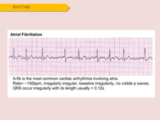 RHYTHM Atrial Fibrillation A-fib is the most common cardiac arrhythmia involving atria. Rate= ~150bpm, irregularly irregular, baseline irregularity, no visible p waves, QRS occur irregularly with its length usually < 0.12s 