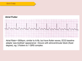 RHYTHM Atrial Flutter Atrial Rate=~300bpm, similar to A-fib, but have flutter waves, ECG baseline adapts ‘saw-toothed’ appearance’. Occurs with atrioventricular block (fixed degree), eg: 3 flutters to 1 QRS complex:  