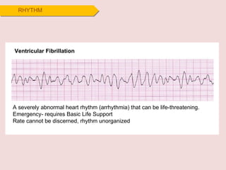 RHYTHM Ventricular Fibrillation A severely abnormal heart rhythm (arrhythmia) that can be life-threatening. Emergency- requires Basic Life Support Rate cannot be discerned, rhythm unorganized 