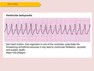 RHYTHM Ventricular tachycardia fast heart rhythm, that originates in one of the ventricles- potentially life-threatening arrhythmia because it may lead to ventricular fibrillation, asystole, and sudden death. Rate=100-250bpm 