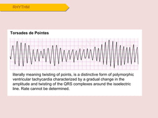 RHYTHM Torsades de Pointes literally meaning twisting of points, is a distinctive form of polymorphic ventricular tachycardia characterized by a gradual change in the amplitude and twisting of the QRS complexes around the isoelectric line. Rate cannot be determined.  