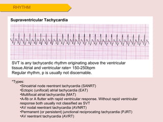 RHYTHM Supraventricular Tachycardia SVT is any tachycardic rhythm originating above the ventricular tissue.Atrial and ventricular rate= 150-250bpm Regular rhythm, p is usually not discernable. *Types: Sinoatrial node reentrant tachycardia (SANRT) Ectopic (unifocal) atrial tachycardia (EAT) Multifocal atrial tachycardia (MAT) A-fib or A flutter with rapid ventricular response. Without rapid ventricular response both usually not classified as SVT AV nodal reentrant tachycardia (AVNRT) Permanent (or persistent) junctional reciprocating tachycardia (PJRT) AV reentrant tachycardia (AVRT) 