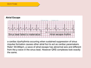 RHYTHM Atrial Escape a cardiac dysrhythmia occurring when sustained suppression of sinus impulse formation causes other atrial foci to act as cardiac pacemakers. Rate= 60-80bpm, p wave of atrial escape has abnormal axis and different from the p wave in the sinus beat. However QRS complexes look exactly the same. 