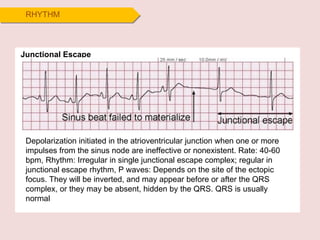 RHYTHM Junctional Escape Depolarization initiated in the atrioventricular junction when one or more impulses from the sinus node are ineffective or nonexistent. Rate: 40-60 bpm, Rhythm: Irregular in single junctional escape complex; regular in junctional escape rhythm, P waves: Depends on the site of the ectopic focus. They will be inverted, and may appear before or after the QRS complex, or they may be absent, hidden by the QRS. QRS is usually normal 