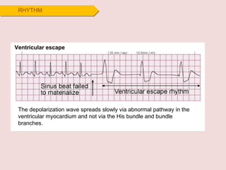 RHYTHM Ventricular escape The depolarization wave spreads slowly via abnormal pathway in the ventricular myocardium and not via the His bundle and bundle branches.  