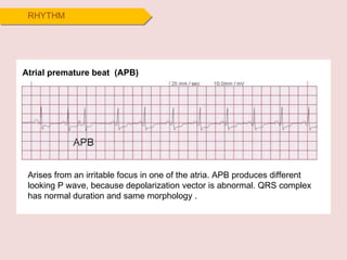 RHYTHM Atrial premature beat  (APB) Arises from an irritable focus in one of the atria. APB produces different looking P wave, because depolarization vector is abnormal. QRS complex has normal duration and same morphology . 
