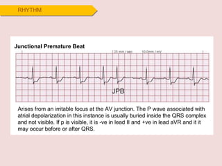 RHYTHM Junctional Premature Beat Arises from an irritable focus at the AV junction. The P wave associated with atrial depolarization in this instance is usually buried inside the QRS complex and not visible. If p is visible, it is -ve in lead II and +ve in lead aVR and it it may occur before or after QRS.  