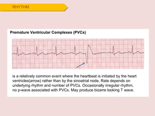 RHYTHM Premature Ventricular Complexes (PVCs) is a relatively common event where the heartbeat is initiated by the heart ventricles(arrow) rather than by the sinoatrial node, Rate depends on underlying rhythm and number of PVCs. Occasionally irregular rhythm,  no p-wave associated with PVCs. May produce bizarre looking T wave. 