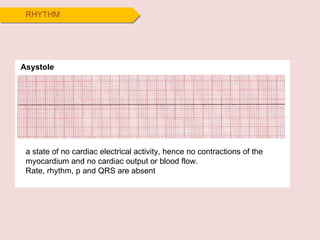 RHYTHM Asystole a state of no cardiac electrical activity, hence no contractions of the myocardium and no cardiac output or blood flow. Rate, rhythm, p and QRS are absent  