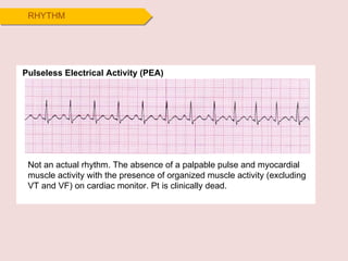RHYTHM Pulseless Electrical Activity (PEA) Not an actual rhythm. The absence of a palpable pulse and myocardial muscle activity with the presence of organized muscle activity (excluding VT and VF) on cardiac monitor. Pt is clinically dead. 