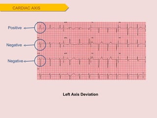 Positive Negative Negative Left Axis Deviation CARDIAC AXIS 