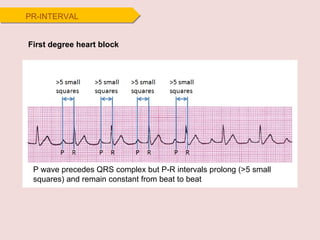 PR-INTERVAL First degree heart block P wave precedes QRS complex but P-R intervals prolong (>5 small squares) and remain constant from beat to beat 