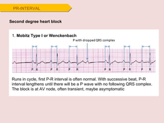 Second degree heart block 1.  Mobitz Type I or Wenckenbach Runs in cycle, first P-R interval is often normal. With successive beat, P-R interval lengthens until there will be a P wave with no following QRS complex.  The block is at AV node, often transient, maybe asymptomatic PR-INTERVAL 