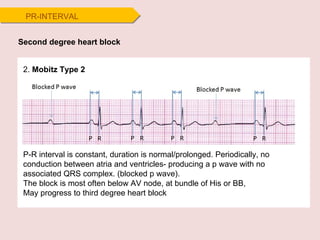 Second degree heart block 2.  Mobitz Type 2 P-R interval is constant, duration is normal/prolonged. Periodically, no conduction between atria and ventricles- producing a p wave with no associated QRS complex. (blocked p wave).  The block is most often below AV node, at bundle of His or BB, May progress to third degree heart block PR-INTERVAL 
