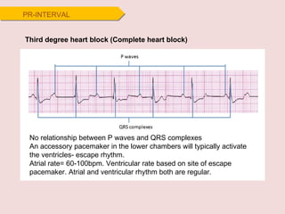 Third degree heart block (Complete heart block) No relationship between P waves and QRS complexes An accessory pacemaker in the lower chambers will typically activate the ventricles- escape rhythm. Atrial rate= 60-100bpm. Ventricular rate based on site of escape pacemaker. Atrial and ventricular rhythm both are regular. PR-INTERVAL 