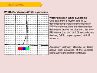 PR-INTERVAL Wolff–Parkinson–White syndrome Accessory pathway (Bundle of Kent) allows early activation of the ventricle (delta wave and short PR interval) Wolf Parkinson White Syndrome One beat from a rhythm strip in V2 demonstrating characteristic findings in WPW syndrome. Note the characteristic delta wave (above the blue bar), the short PR interval (red bar) of 0.08 seconds, and the long QRS complex (green) at 0.12 seconds 