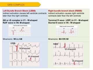 QRS COMPLEX Left Bundle Branch Block (LBBB) indirect activation causes left ventricle contracts later than the right ventricle . Right bundle branch block (RBBB) indirect activation causes right ventricle contracts later than the left ventricle QS or rS complex in V1 - W-shaped RsR' wave in V6- M-shaped Terminal R wave  (rSR’) in V1 - M-shaped Slurred S wave in V6 - W-shaped Mnemonic:  W IL L IA M Mnemonic:  M AR R O W 