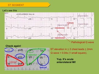 Check again! >2mm Yup, It’s acute anterolateral MI! Let’s see this ST elevation in  >  2 chest leads  >  2mm Pathological Q wave Q wave > 0.04s (1 small square). ST SEGMENT I II III aVR aVL aVF V1 V2 V3 V4 V5 V6 