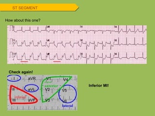 Check again! Inferior MI! How about this one? ST SEGMENT I II III aVR aVL aVF V1 V2 V3 V4 V5 V6 