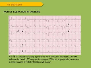 ST SEGMENT NON ST-ELEVATION MI (NSTEMI) N-STEMI: acute coronary syndrome (with troponin increase). Arrows indicate ischemic ST segment changes. Without appropriate treatment in many cases STEMI infarction will occur. 