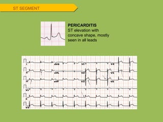 ST SEGMENT ST elevation with concave shape, mostly seen in all leads PERICARDITIS 