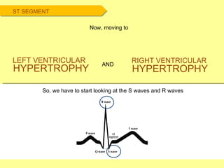 ST SEGMENT Now, moving to LEFT VENTRICULAR HYPERTROPHY RIGHT VENTRICULAR HYPERTROPHY AND So, we have to start looking at the S waves and R waves 