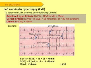 ST SEGMENT Left ventricular hypertrophy (LVH) Example: Sokolow & Lyon Criteria : S (V1) + R(V5 or V6) > 35mm Cornell Criteria : S (V3) + R (aVL) > 28 mm (men) or > 20 mm (women) Others : R (aVL) > 13mm  S (V1) + R(V5) = 15 + 25 =  40mm S(V3) + R (aVL)= 15 + 14 = 29mm R(aVL) = 14 mm LVH! To determine LVH, use one of the following Criteria: 
