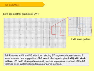 Tall R waves in V4 and V5 with down sloping ST segment depression and T wave inversion are suggestive of left ventricular hypertrophy ( LVH) with strain pattern.  LVH with strain pattern usually occurs in pressure overload of the left ventricle as in systemic hypertension or aortic stenosis.  Let’s see another example of LVH LVH strain pattern ST SEGMENT 