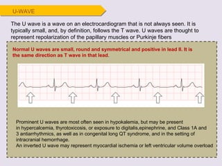 U-WAVE Prominent U waves are most often seen in hypokalemia, but may be present in hypercalcemia, thyrotoxicosis, or exposure to digitalis,epinephrine, and Class 1A and 3 antiarrhythmics, as well as in congenital long QT syndrome, and in the setting of intracranial hemorrhage. An inverted U wave may represent myocardial ischemia or left ventricular volume overload The U wave is a wave on an electrocardiogram that is not always seen. It is typically small, and, by definition, follows the T wave. U waves are thought to represent repolarization of the papillary muscles or Purkinje fibers Normal U waves are small, round and symmetrical and positive in lead II. It is the same direction as T wave in that lead . 