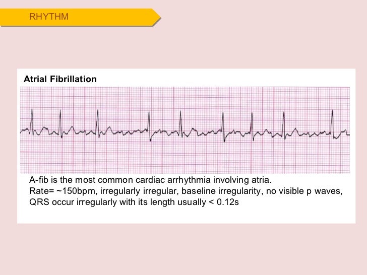 How To Calculate Atrial Rate In Atrial Fibrillation Rating Walls