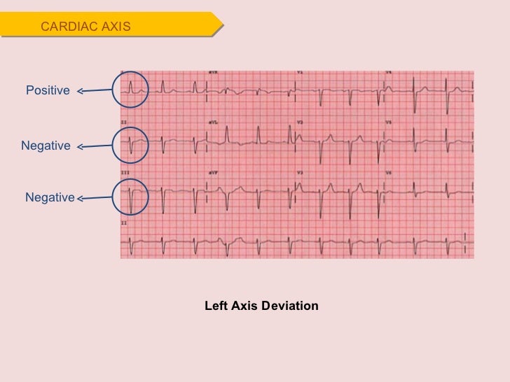 What is left axis deviation?