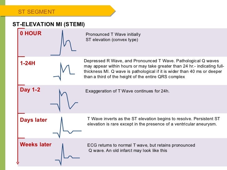 stemi ecg change time에 대한 이미지 검색결과