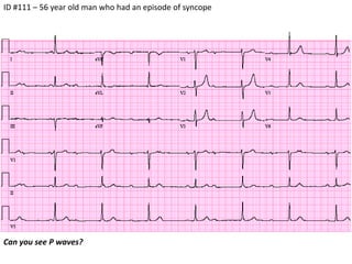 ID #111 – 56 year old man who had an episode of syncope  Can you see P waves?