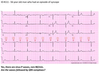 ID #111 - 56 year old man who had an episode of syncopeYes, there are sinus P waves, rare 80/min.Are the waves followed by QRS complexes?