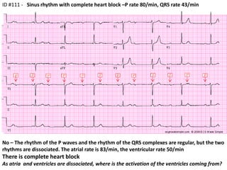 ID #111 -   Sinus rhythm with complete heart block –P rate 80/min, QRS rate 43/min  No – The rhythm of the P waves and the rhythm of the QRS complexes are regular, but the two rhythms are dissociated. The atrial rate is 83/min, the ventricular rate 50/min There is complete heart blockAs atria  and ventricles are dissociated, where is the activation of the ventricles coming from?