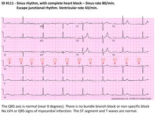 ID #111 - Sinus rhythm, with complete heart block – Sinus rate 80/min.                Escape junctional rhythm. Ventricular rate 43/min.The QRS axis is normal (near 0 degrees). There is no bundle branch block or non-specific blockNo LVH or QRS signs of myocardial infarction. The ST segment and T waves are normal.