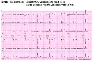 ID #111 Final diagnosis:    Sinus rhythm, with complete heart block –                                              Escape junctional rhythm. Ventricular rate 43/min.