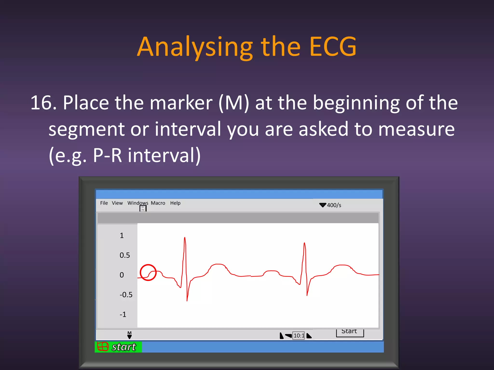 Analysing the ECG
16. Place the marker (M) at the beginning of the
  segment or interval you are asked to measure
  (e.g. P-R interval)
       File View Windows Macro Help            400/s
                          Xt
                          2y


             1                                  2mV
             0
                                             lead 1
             -1
                 1
            1

                                             lead 2
            0
                 0.5
            -1


            1    0
            0
                                             lead 3
            -1
                 -0.5
            1

                                             lead 4
            0
                 -1
            -1


                      M                                Start
                                      10:1
 