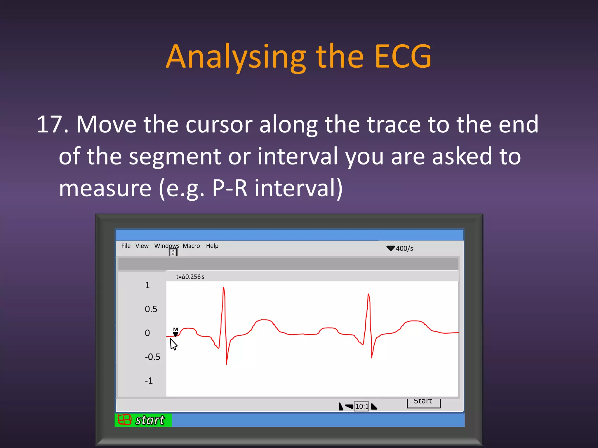 Analysing the ECG
17. Move the cursor along the trace to the end
  of the segment or interval you are asked to
  measure (e.g. P-R interval)
       File View Windows Macro Help                400/s
                        Xt
                        2y


             1                                      2mV
             0
                             t=∆0.256 s          lead 1
             -1
                 1
            1

                                                 lead 2
            0
                 0.5
            -1

                         M
            1    0
            0
                                                 lead 3
            -1
                 -0.5
            1

                                                 lead 4
            0
                 -1
            -1


                                                           Start
                                          10:1
 
