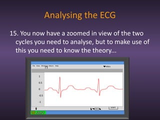Ecg | PPTX | Heart and Cardiovascular Diseases | Diseases and Conditions