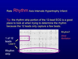 Ecg | PPT