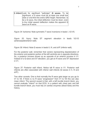 3. Infarct Look for significant "patholgic" Q waves. To be
significant, a Q wave must be at least one small box
wide or one-third the entire QRS height. Remember, to
be a Q wave, the initial deflection must be down; even
a tiny initial upward deflection makes the apparent Q
wave an R wave.
Figure 34: Ischemia: Note symmetric T wave inversions in leads I, V2-V5.
Figure 35: Injury: Note ST segment elevation in leads V2-V3
(anteroseptal/anterior wall).
Figure 36: Infarct: Note Q waves in leads II, III, and aVF (inferior wall).
For the posterior wall, remember that vectors representing depolarization of
the anterior and posterior portion of the left ventricle are in opposite directions.
So, a posterior process shows up as opposite of an anterior process in V1.
Instead of a Q wave and ST elevation, you get an R wave and ST depression
in V1.
Figure 37: Posterior wall infarct. Notice tall R wave in V1. Posterior wall
infarcts are often associated with inferior wall infarcts (Q waves in II, III and
aVF).
Two other caveats: One is that normally the R wave gets larger as you go to
V1 to V6. If there is no R wave "progression" from V1 to V6 this can also
mean infarct. The second caveat is that, with a left bundle branch block, you
cannot evaluate "infarct" on that ECG. In a patient with chest pain and left
bundle branch block, you must rely on cardiac enzymes (blood tests) and the
history.
7
 